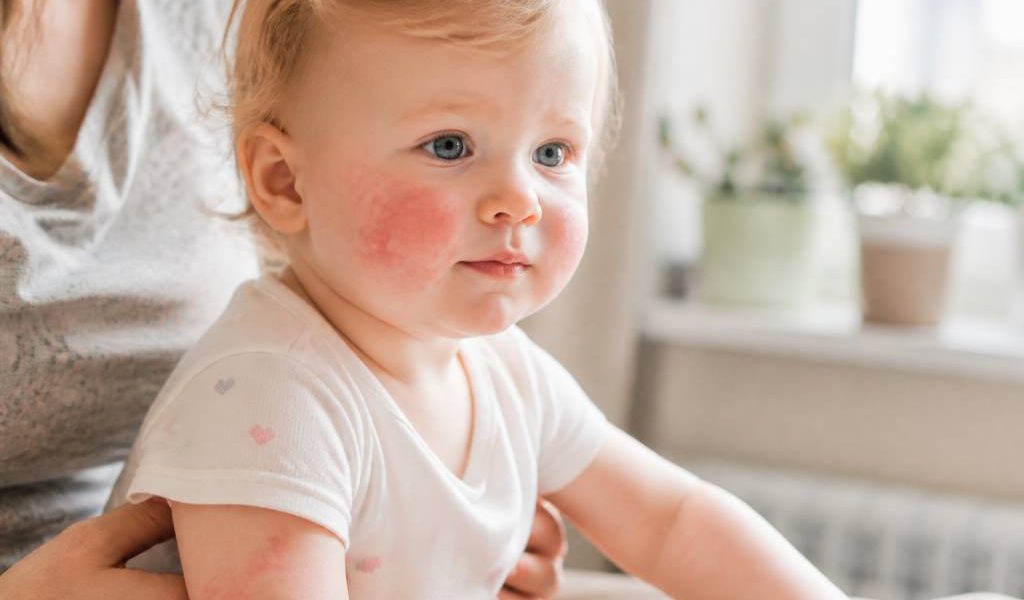 5ème maladie bébé : symptômes, contagion et conseils aux parents