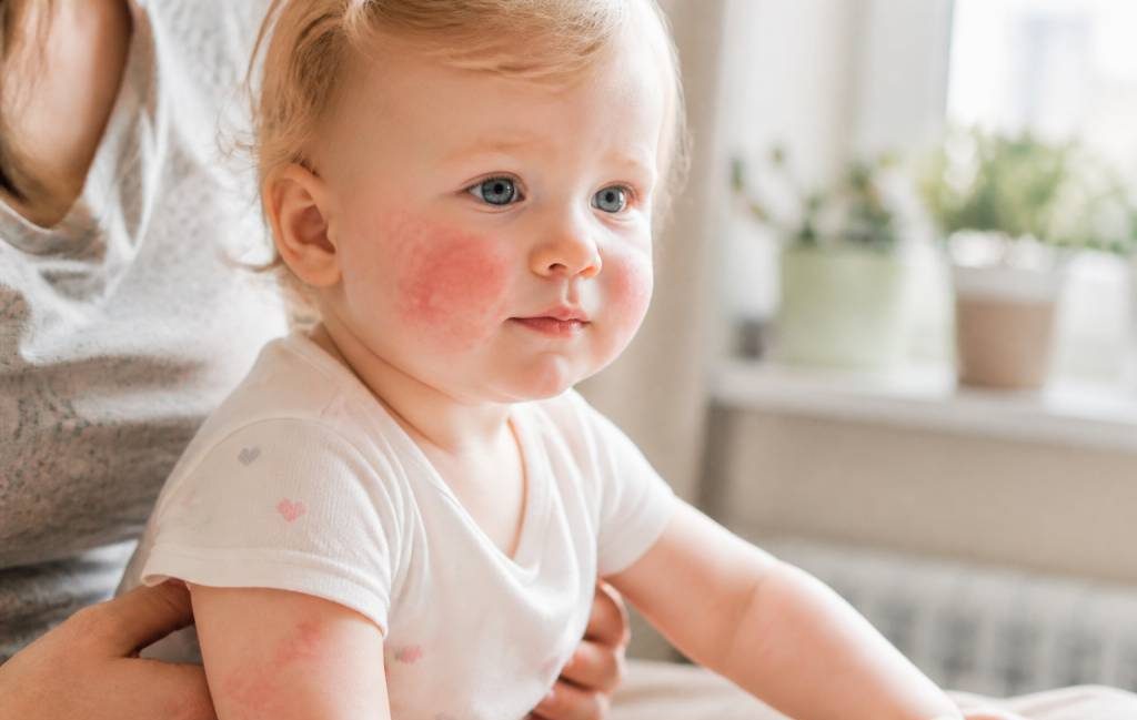 5ème maladie bébé : symptômes, contagion et conseils aux parents