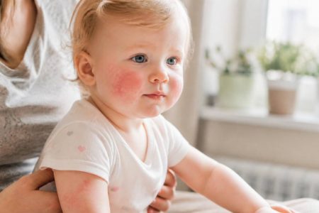 5ème maladie bébé : symptômes, contagion et conseils aux parents